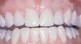 Khám phá sự thật về phương pháp bọc răng sứ không kim loại
