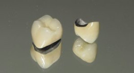 Bọc răng sứ kim loại (Titan) – Hãy đọc những thông tin cần thiết ngay bây giờ