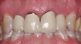 Bọc Răng Sứ phần chân răng bị hở – Biện pháp khắc phục Hiệu Quả 99%