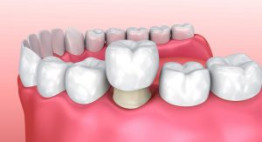 Quá trình bọc răng sứ chữa hô của anh chàng “soái ca”