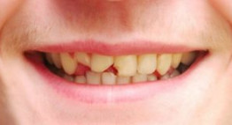 Hàn răng bị mẻ – Liệu pháp chỉnh sửa răng mẻ phục hình răng chuyên sâu
