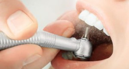 Mài răng nanh bọc sứ cho răng bị mọc lệch lạc và quá khổ