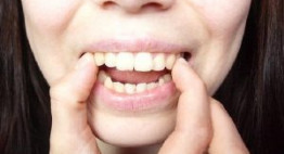Nhiều khách hàng đã tìm ra đúng cách làm răng bớt hô cho mình