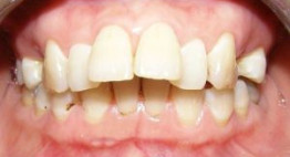 Muốn biết răng hô phải làm sao, đừng bỏ lỡ các thông tin quan trọng từ chuyên gia nha khoa