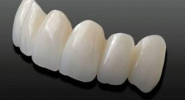 Sử dụng răng sứ Cercon có tốt không? – Đánh giá thực tế cho người dùng