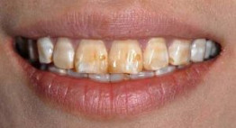 Làm lại răng cửa đẹp nhất hiện nay bằng cách nào?