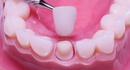 Trồng răng sứ mất bao lâu là chuẩn xác nhất- Bạn đã biết chưa?