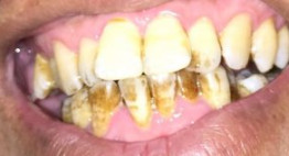 Phải làm sao với hàm răng xấu, khấp khểnh, men răng vàng ố?