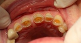 Bọc răng sứ thẩm mỹ khắc phục tình trạng răng bị mòn mặt nhai