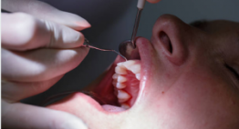 Bọc Răng Sứ cho răng đã chết tủy có nên không? – BS tư vấn