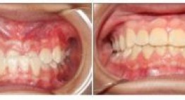 Bạn nên thực hiện bọc răng sứ cho răng móm ngay hôm nay!