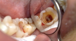 Có nên bọc răng sứ cho răng sâu không? – Giải đáp từ chuyên gia