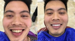 Bọc răng sứ không lấy tủy – Những LỢI ÍCH thiết thực bạn nên hiểu rõ