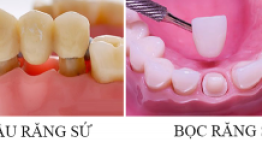 Bọc răng sứ và làm cầu răng có gì khác nhau?