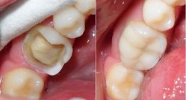 Bọc Sứ cho Răng Hàm nên chọn loại nào thì TỐT và AN TOÀN << Xem ngay