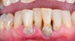 Răng lung lay có bọc răng sứ được không? – [Kiểm chứng thực tế]