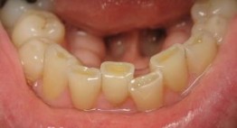 Có nên BỌC RĂNG SỨ cho hàm răng bị mòn men hay không? – Xem ngay