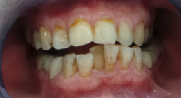 Bọc răng sứ cho răng mọc lệch, khấp khểnh – Giải pháp hiệu quả nhất