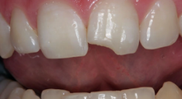 Bỏ ra 2 ngày để phục hình răng sứt mẻ với bọc răng sứ