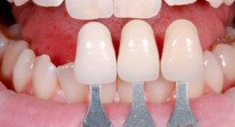 Cảnh báo: Những điều bạn phải biết về bọc răng sứ không cần mài răng