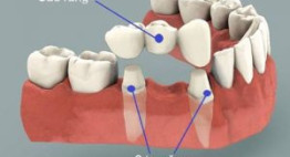 Mất 1 răng có thể trồng răng bằng cách nào? – Phục hình răng hiệu quả