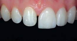 Bọc răng sứ khắc phục hàm răng có kích thước không đều nhau?