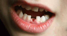 Mất 1 răng có bọc răng sứ được không?