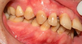 Răng hô nên bọc răng sứ hay niềng răng để mang lại hàm răng đều đẹp?