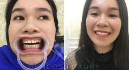 Răng ngắn dài ra với phương pháp bọc răng sứ thẩm mỹ [Bạn tin không?]