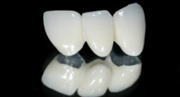 Tiêu chí quan trọng giúp bạn tìm hiểu địa chỉ làm răng sứ kim loại bền đẹp, chất lượng cao