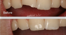 Bị Mẻ Răng Cửa Có Trám Được Không? – Tư vấn từ BS nha khoa