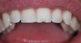 Bị mẻ răng khi đang mang thai có Bọc Răng Sứ được không? – BS tư vấn