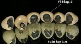Bọc Răng Sứ Kim Loại Thường có tốt không? – Những mặt lợi và hại