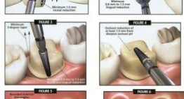 Bọc Răng Sứ và những hiểu lầm tai hại về phương pháp thẩm mỹ này