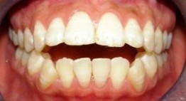 Cảnh Báo: Trường hợp Không Nên Bọc Răng Sứ Thẩm Mỹ < Xem ngay