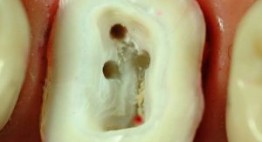 Răng đã lấy tủy bị vỡ phải làm sao để khắc phục?