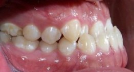 Bạn nên biết Răng Móm có nên Bọc Răng Sứ << Xem ngay  hôm nay