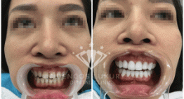 Bọc răng sứ có ảnh hưởng đến răng thật không- Đáp án là đây!