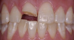 Bọc răng sứ cho trường hợp răng gãy vỡ lớn, hư hỏng chân răng