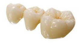 Cầu răng sứ – Phục hình răng mất nhanh chóng, thẩm mỹ