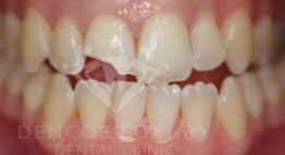 Làm răng cửa giả thẩm mỹ và bền đẹp bằng phương pháp nào hiện nay?