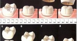 Chi tiết kỹ thuật trồng răng sứ tại Nha khoa Quốc tế Dencos Luxury