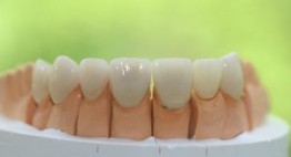 Răng sứ không kim loại – Lựa chọn”chuẩn” trong công nghệ bọc răng sứ