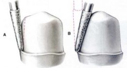 Điểm mặt những nhược điểm của bọc răng sứ thẩm mỹ