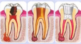 Viêm tủy răng & Những tác hại không thể lường trước được