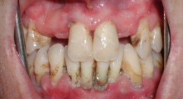 Hiểu rõ vấn đề bệnh nha chu có nguy hiểm không?