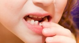 Nhổ răng cho trẻ em- Những điều cha mẹ buộc phải hiểu rõ