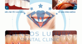Quy trình lấy cao răng đúng chuẩn tại Nha khoa Quốc tế Dencos Luxury