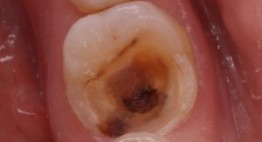 Răng sâu nên hàn trám Composite hay bọc răng sứ để có kết quả tốt?