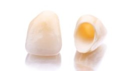 Bọc mão răng sứ- Lựa chọn giải pháp thẩm mỹ răng hiệu quả